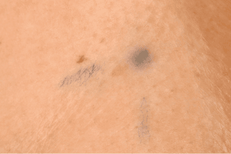 Trial 2_PI_Photo entity_Radiotherapy tattoo marks.
