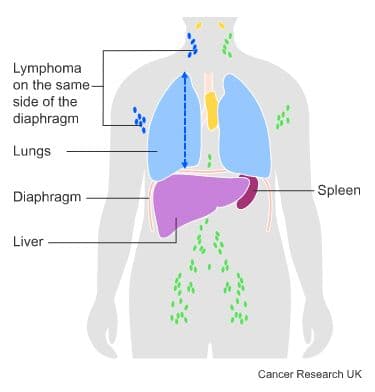Medical diagram - Lymphoma.