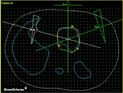 2D radiotherapy plan.