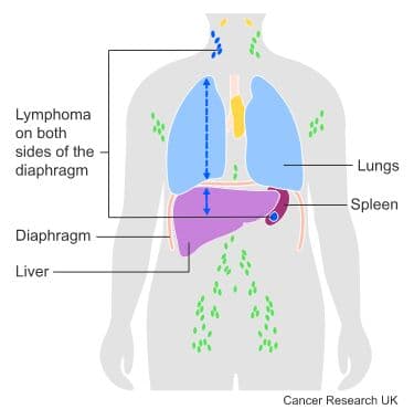 Medical diagram - Lymphoma.