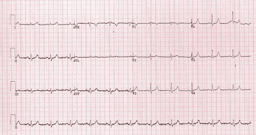 Photo showing an ECG printed on paper.