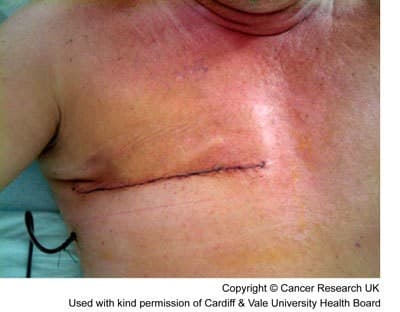 Photograph of a man 1 day after a mastectomy.