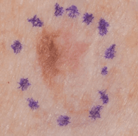 Melanoma that has developed from a changing area of the skin with irregular shape and colour.