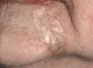 Photograph of morphoeic basal cell carcinoma.