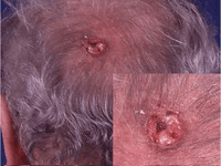 Photograph of squamous cell cancer on scalp .